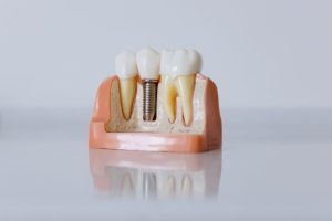 close up shot of a dental implant model 300x200 - close up shot of a dental implant model
